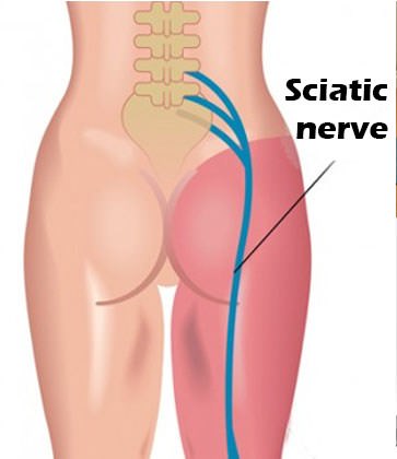 An image showing where the sciatic nerve comes from and how it runs down the leg